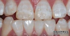 治氟斑牙哪个办法较好？