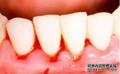牙龈老出血是什么原因？