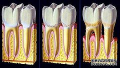 牙根老是发炎怎么办？