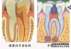 牙髓炎怎么治疗好？