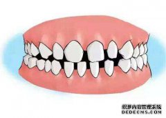 牙齿稀疏的治疗方法有哪些？
