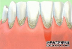牙龈瘘管是什么怎么治疗？