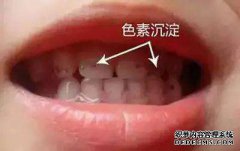 如何预防色素牙？