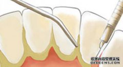 牙结石怎么形成的？该如何治疗呢？