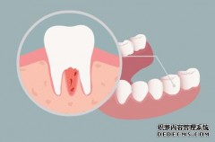 牙周炎的症状有哪些？