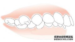 牙齿畸形是由哪些因素所造成的？