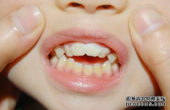 地包天牙齿矫正的黄金年纪是几岁？