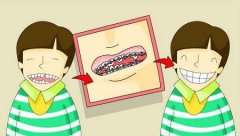 关于儿童牙齿矫正你需要了解什么？
