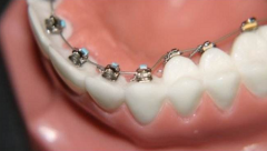 儿童矫正牙齿需要多长时间？