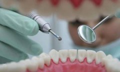儿童补牙，玻璃离子和复合树脂哪个好？