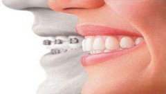 儿童牙齿矫正需要多长时间？都有哪些矫正方式