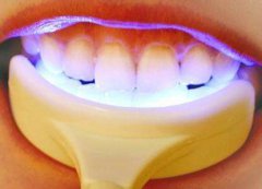 牙齿美白有几种方式？