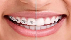 儿童牙齿矫正的4个黄金时期