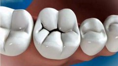 儿童补牙会影响换牙吗？