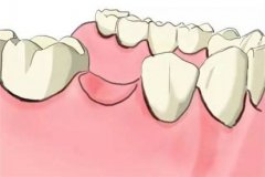 牙齿缺失做哪一种修复方式好？
