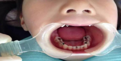 【福州】什么原因导致牙齿上长了洞？怎么补救