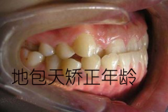 牙齿畸形有分很多种情况，当中地包天这种是