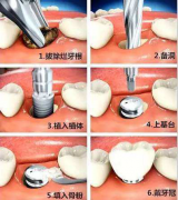 【福州】为何做种植牙时，会说要补胶原蛋白跟