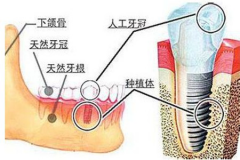 【福州】种植牙是什么？牙缺失为什么要做种植