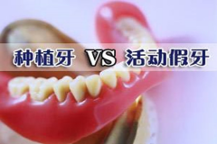 【福州】种植牙耐用还是传统假牙耐用?
