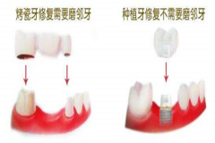 【福州】做种植牙好还是镶牙好?各自的优缺点是