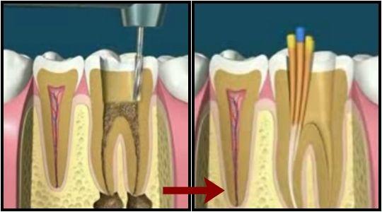 为什么牙齿缺失后医生会尽量保留残根呢？