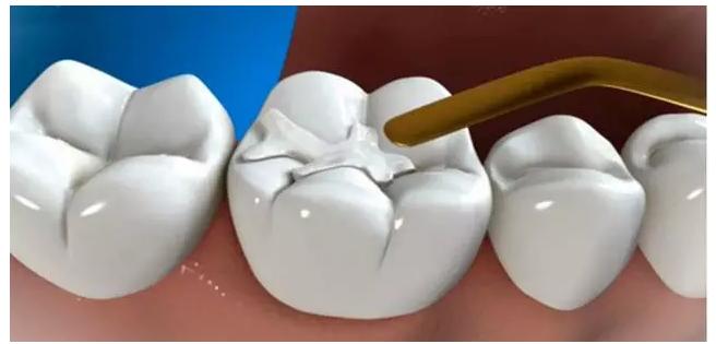 孩子得了龋齿，补牙选哪种材料填充好？