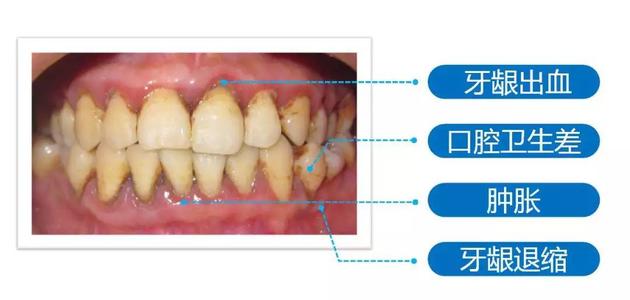 我好像得了牙周病！怎么治！