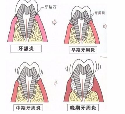 牙周炎这个病症很严重吗？