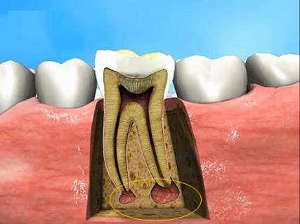 得了根尖周炎怎么办？