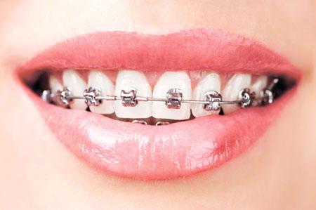【福州】关于牙齿正畸矫正有哪些误区？
