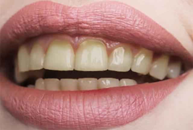 【福州】发黄的牙齿怎么快速变白？