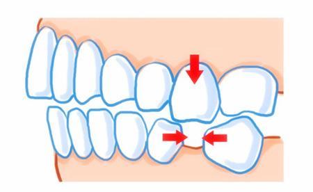 【福州】长期缺牙会带来哪些危害？怎么治疗比