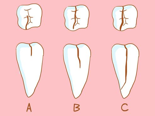 【福州】牙隐裂了是为什么？该怎么治？