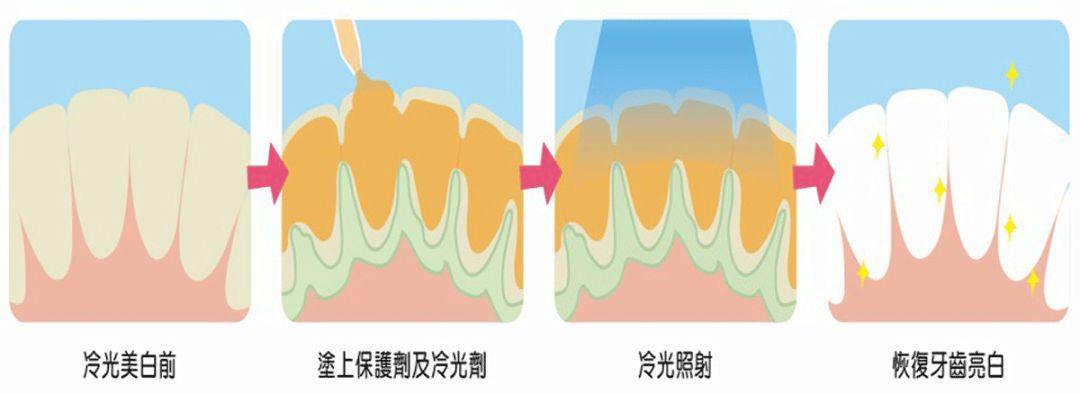 【福州】外源性着色牙怎么变白？冷光美白能起