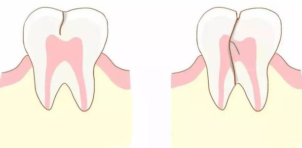 【福州】牙隐裂是什么？要做根管治疗吗？