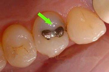 【福州】蛀牙是如何形成的？是否应该尽快补牙