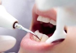 【福州】洗牙是否能与牙齿美白划等号？