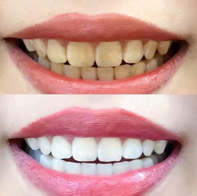 【福州】牙齿美白究竟选哪种方法伤害最小呢？
