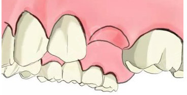【福州】牙齿缺失不镶会有什么危害？