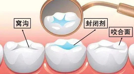 【福州】牙齿涂氟是窝沟封闭吗？