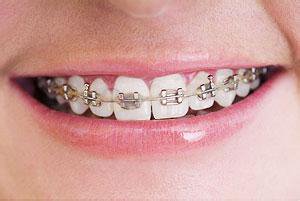 【福州】牙齿矫正时您可能会遇到的一些问题