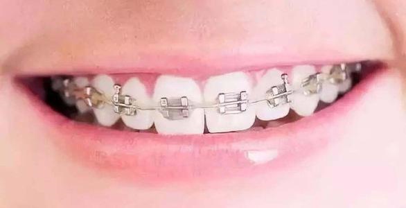 【福州】牙齿矫正有哪些比较要紧的问题