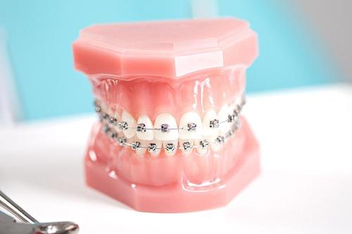 【福州】关于牙齿矫正的答疑