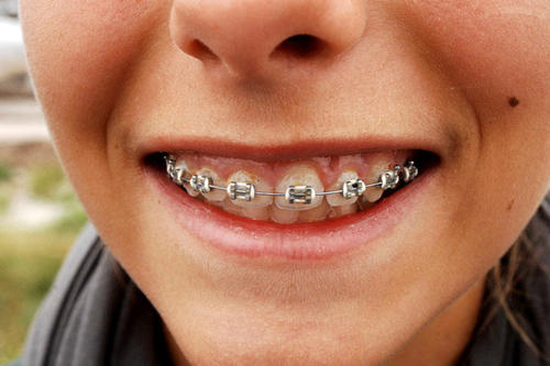 【福州】盘点一些有关牙齿矫正的问题
