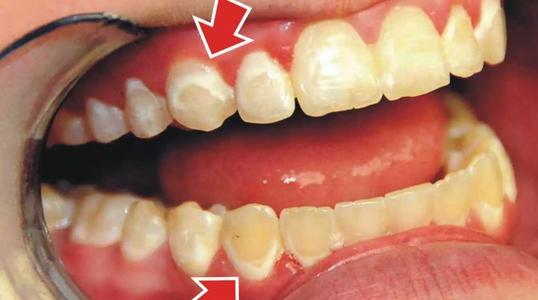 【福州】牙齿矫正过程中出现牙齿脱矿是怎么回