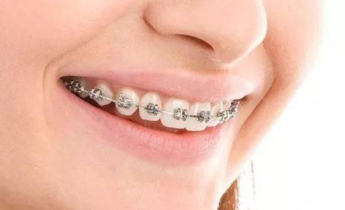 【福州】哪种牙齿矫正方式最适合自己？