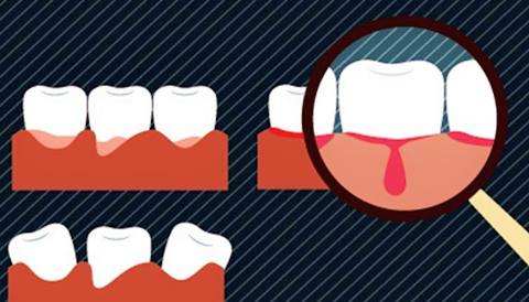 【福州】如何避免牙龈出血？