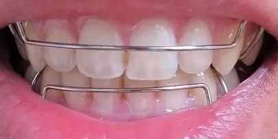 【福州】牙齿矫正为何要戴保持器？