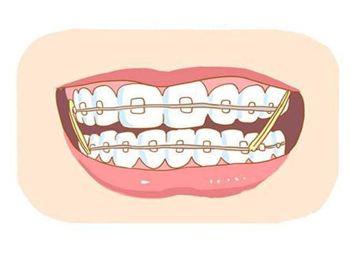 【福州】牙齿矫正让牙齿美观又健康